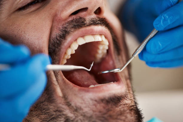 Best Emergency Dental Care for Broken or Chipped Teeth in University Heights, IA